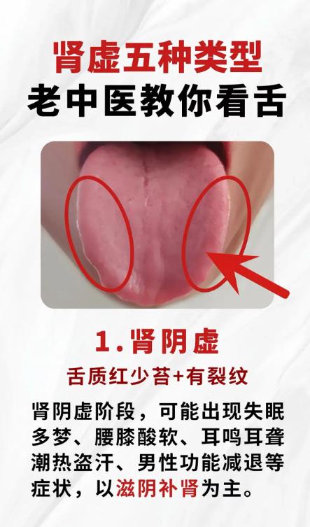 肾虚五大类型，老中医教你观舌自测