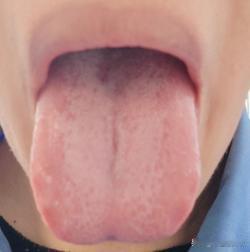 舌诊实战分享：
病人主诉：口干口苦 乏力 冷热都怕 睡眠一般 阴囊潮湿 早泄

