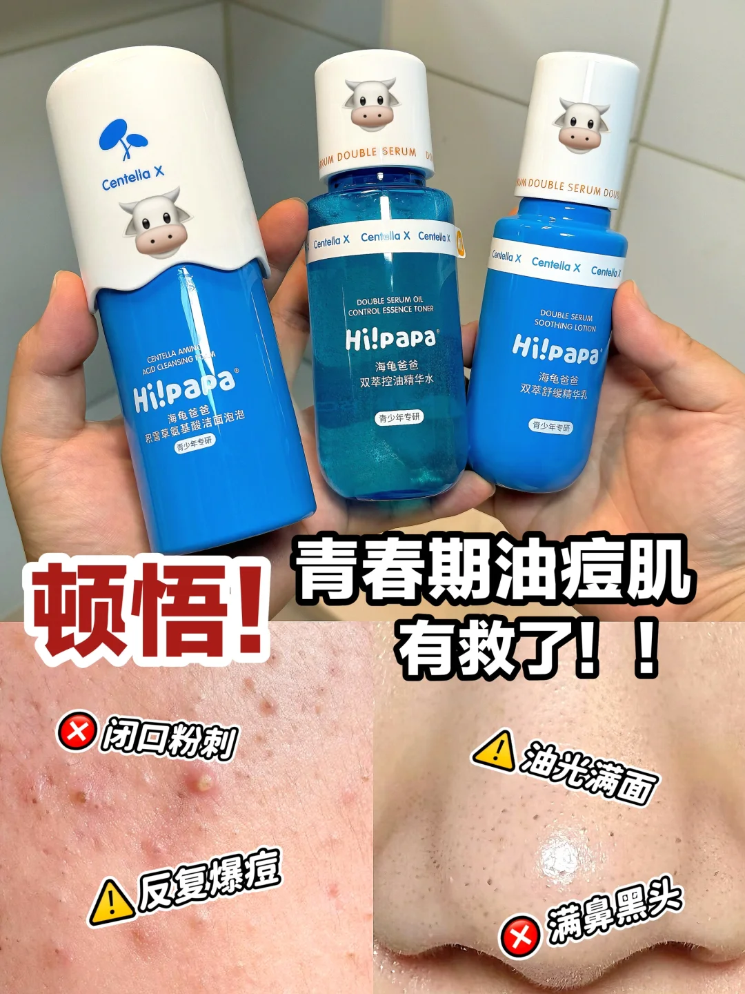 痘痘刺客，青少年祛痘套装这么牛的吗~