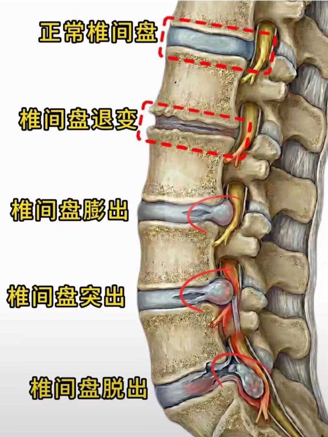 一秒看懂腰椎问题！