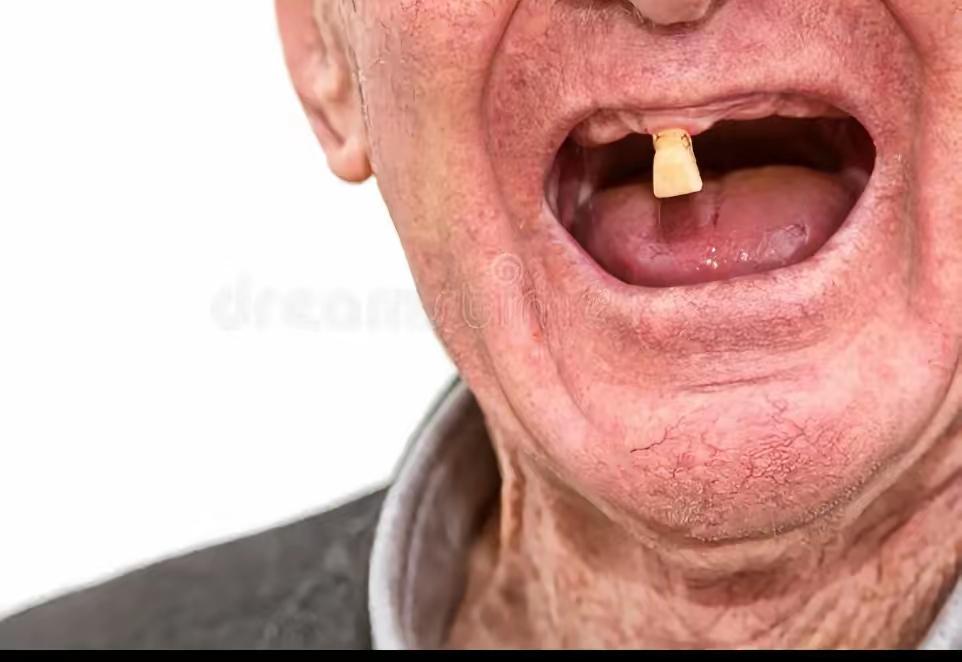 给九旬老人配假牙有多难呢？前几年配的假牙，随着原生牙的逐渐脱落已经无法固定。所以