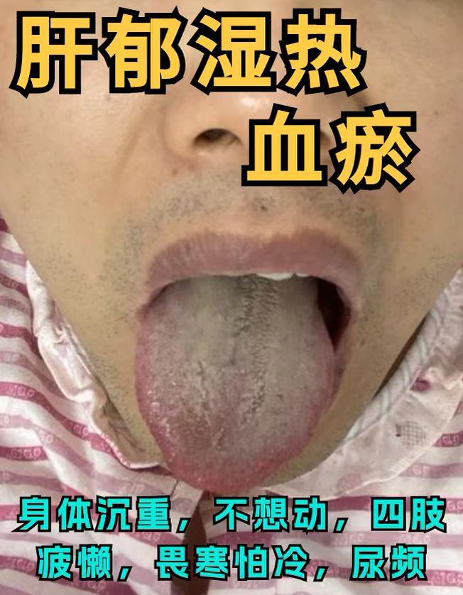 今日舌象分析中......看看你是哪一种