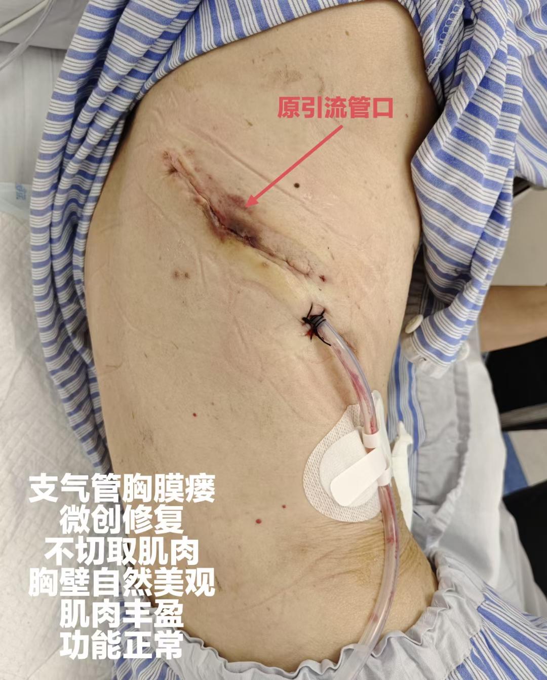 右肺中下叶切除术后支气管胸膜瘘微创修复治。江西护士的妈妈，右肺中下叶切除术后，支气管胸膜瘘，难道只能终身带管？微创修复术后近一年，复查治愈，外观功能正常，回归正常生活。