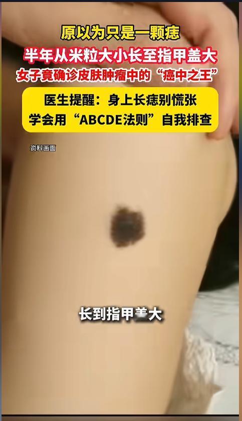 “别再当成痣了！”近日，湖北武汉，一女子半年前身上长了个黑点，只有米粒大小，她自
