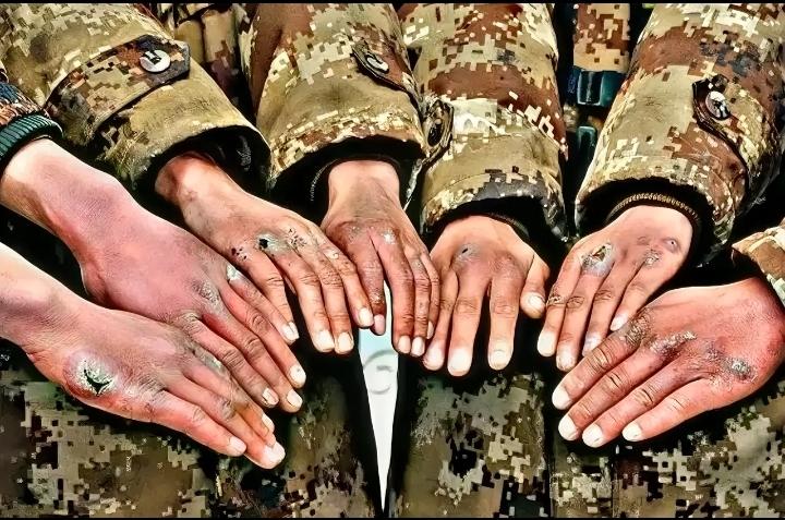 这是我们边防战士的手，在极寒的边防区，他们的手被冻得全是脓疮，依然不撤离岗位半步