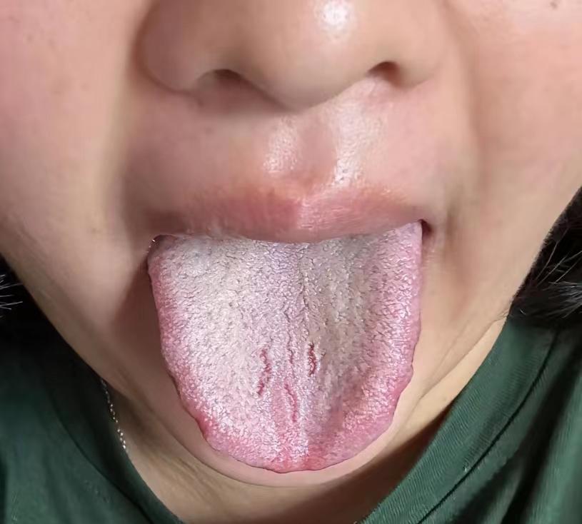 小姑娘才23岁，身体糟糕透了！舌苔白腻微黄
寒、热、淤，自己全部占了[皱眉]，每