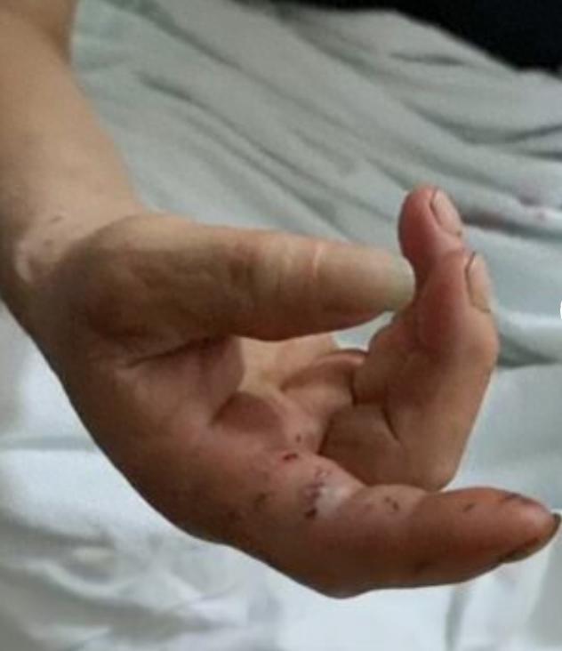 广西横州一被蛇咬伤女子不幸离世，救助者：因道路不通，辗转多次才送医治疗，看到时女