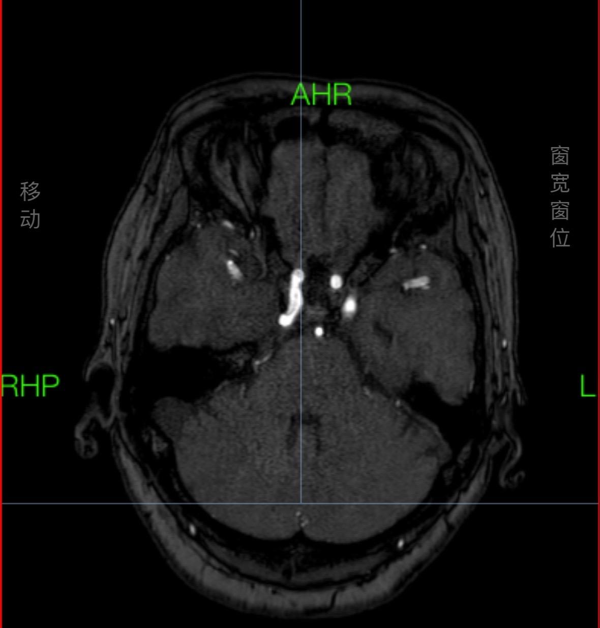 充实着每一天。今天一天三叉神经痛行微血管减压，一台痛行球囊，一台脑的骨头缺损，缺乏颅骨保护，行颅骨修补，三台术后复查CT可