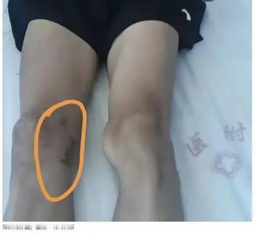 闹大了！广西17岁体育特长生手术遭误切，百色三甲医院管理失误引众怒





古