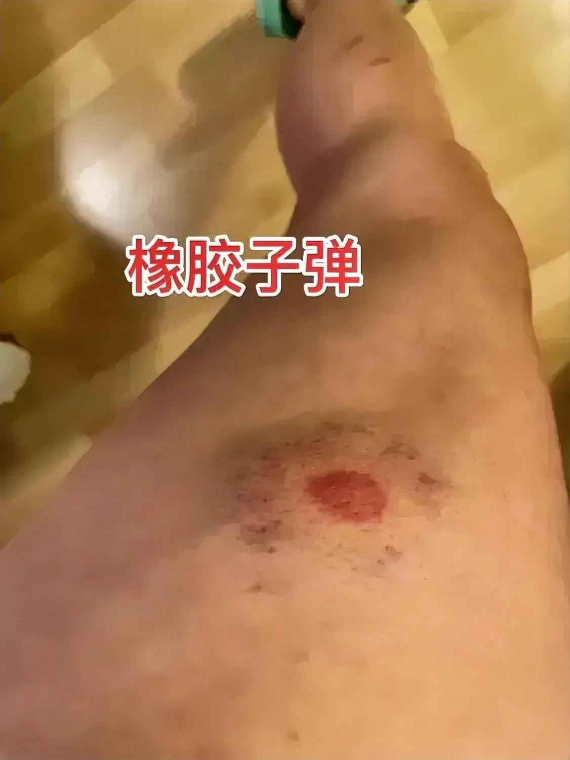 橡胶子弹！[发怒]
这种形态，叫“印痕样挫伤”！

损伤很有特点，中间一个红点，