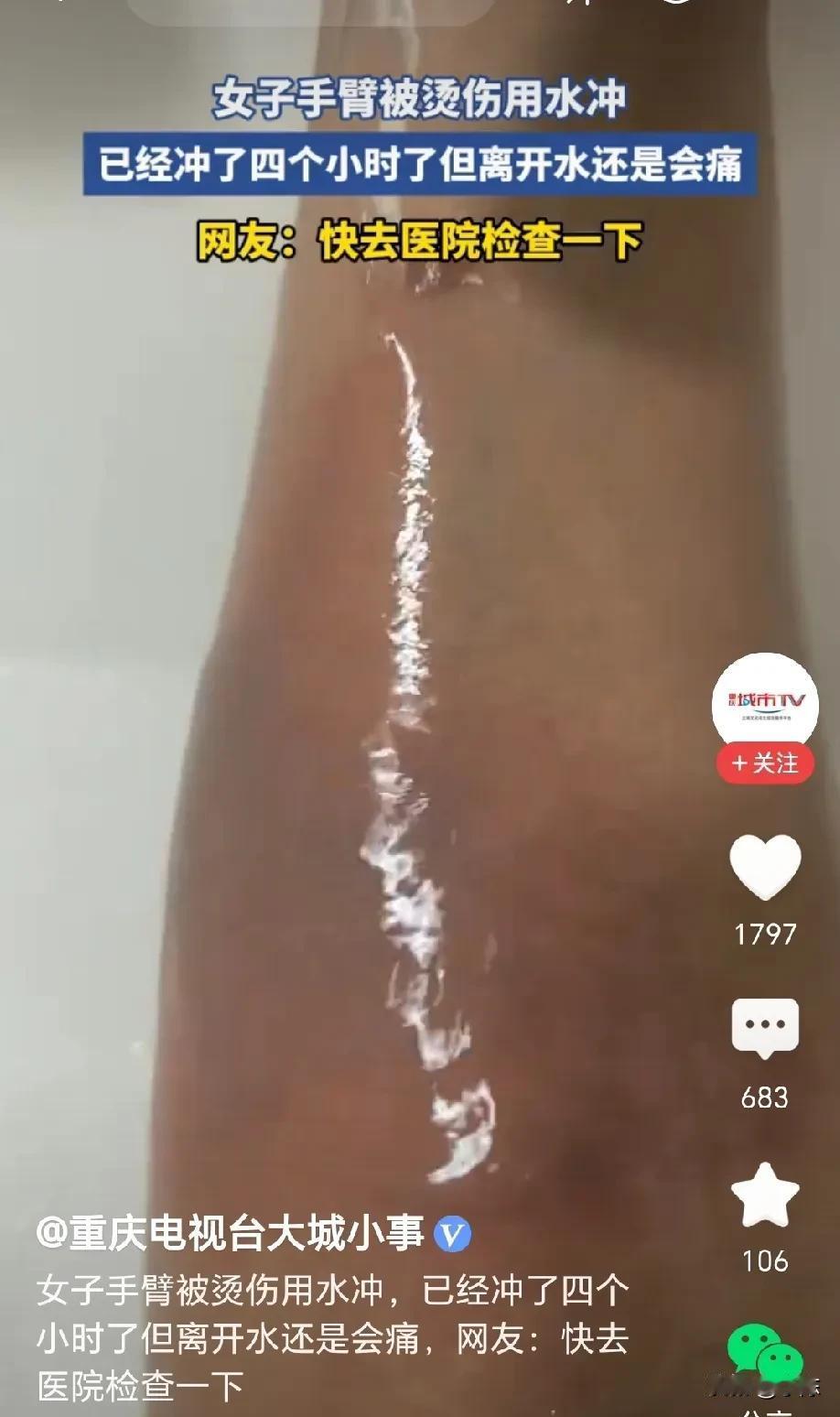 左右为难啊！山东一女子手臂被烫伤，她第一时间打开水龙头用凉水降温，可她不清楚冲多