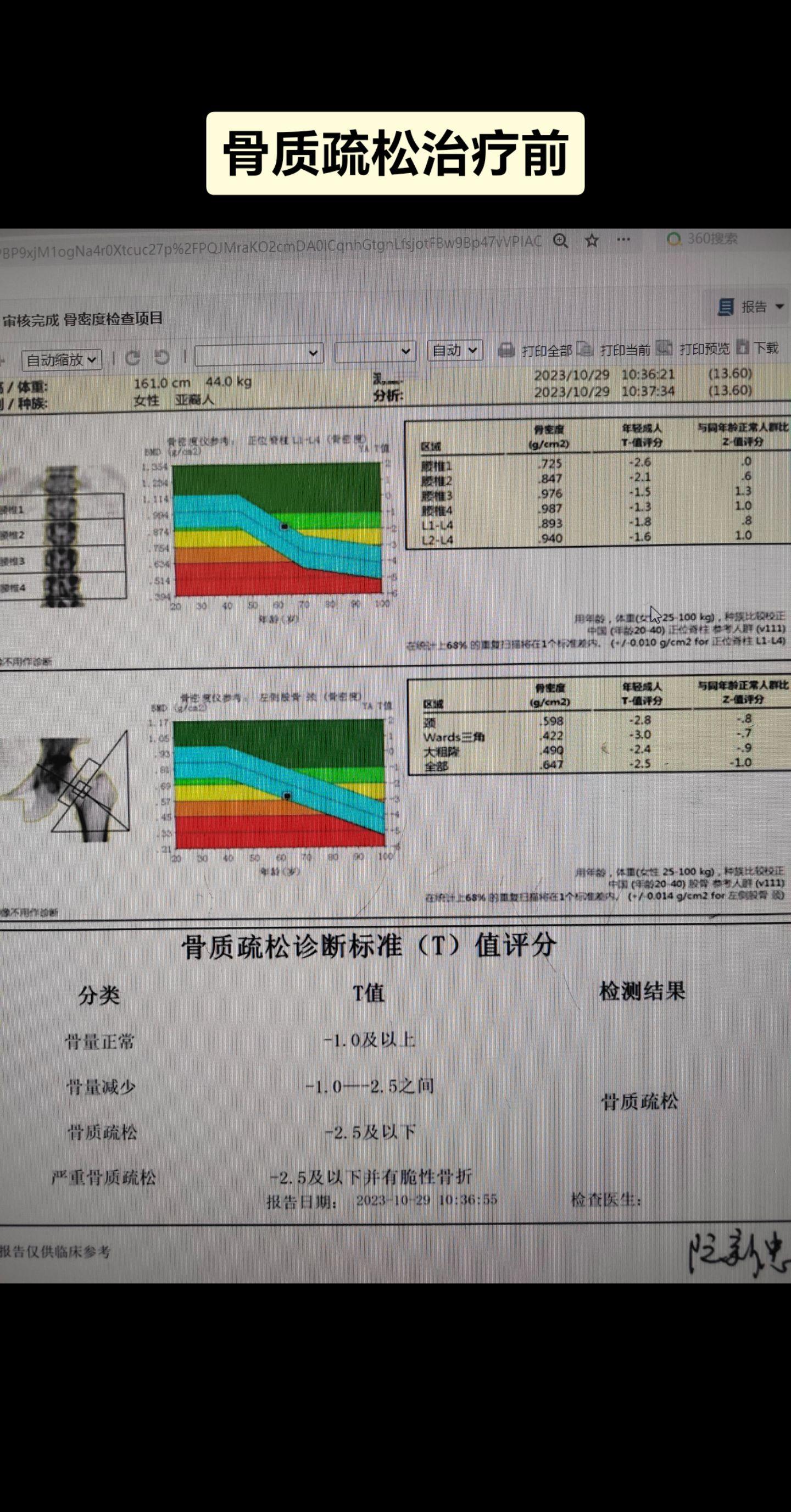 骨质疏松治疗前后对比。患者原本四肢麻木，已经准备做脊柱手术，经过半年的骨质疏松治疗，骨密度提高，四肢麻木的症状也明显改善。。提示我们老年患者很多神经症状应用骨质疏松治疗可以改善症状。
