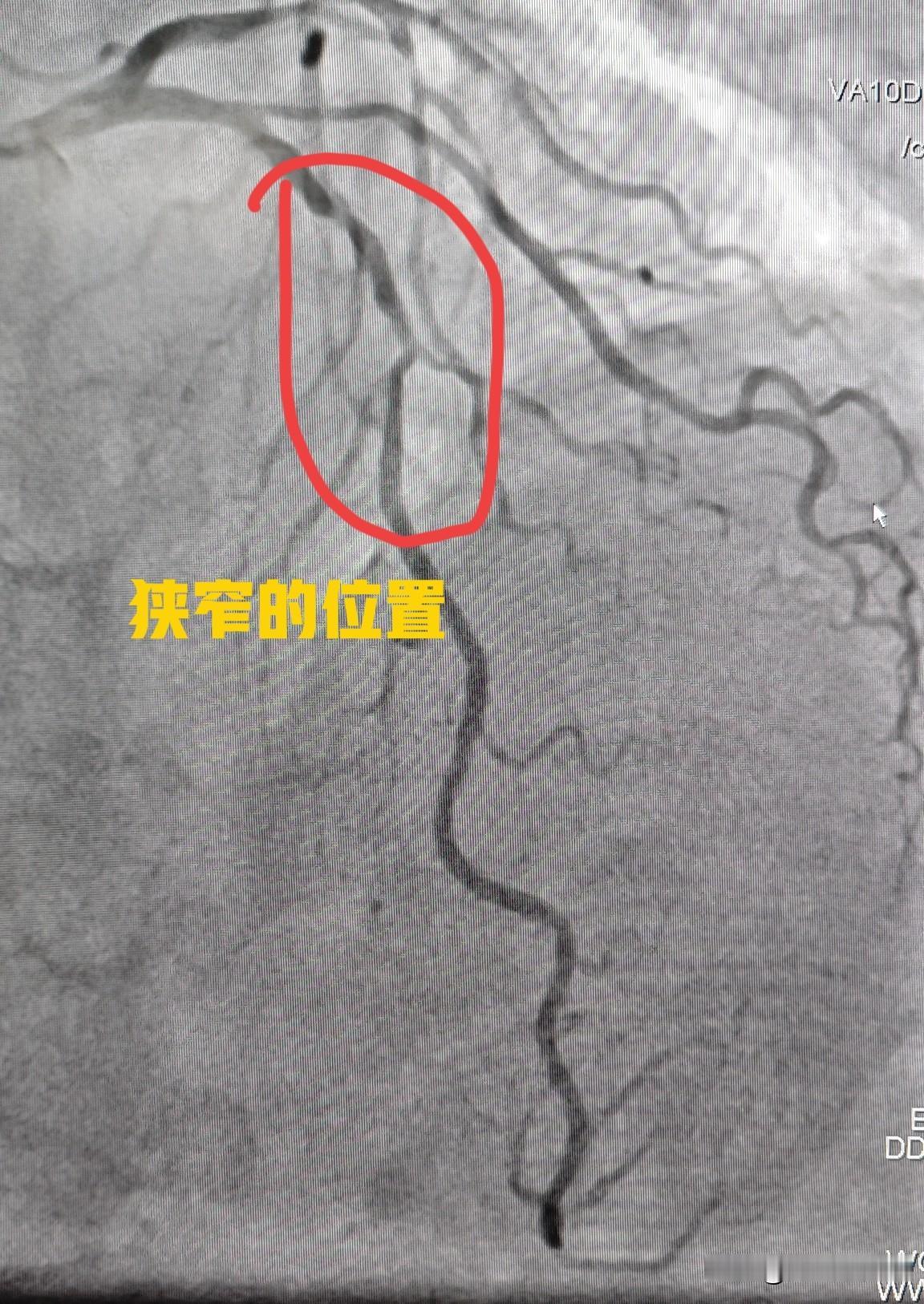 78 岁老人冠心病药物保守治疗。今天给一个78岁老年女性的冠心病患者做了心脏造影