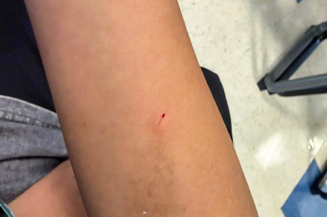 总在记忆里 （1599）：弟弟做完皮试，医生连根棉棒都不给，于是他用手按着就走了