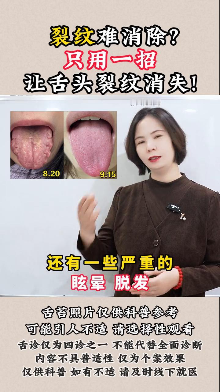 裂纹难消除？只用一招让舌头裂纹消失！

这个患者是个女性，舌头上铺满了整个裂纹。