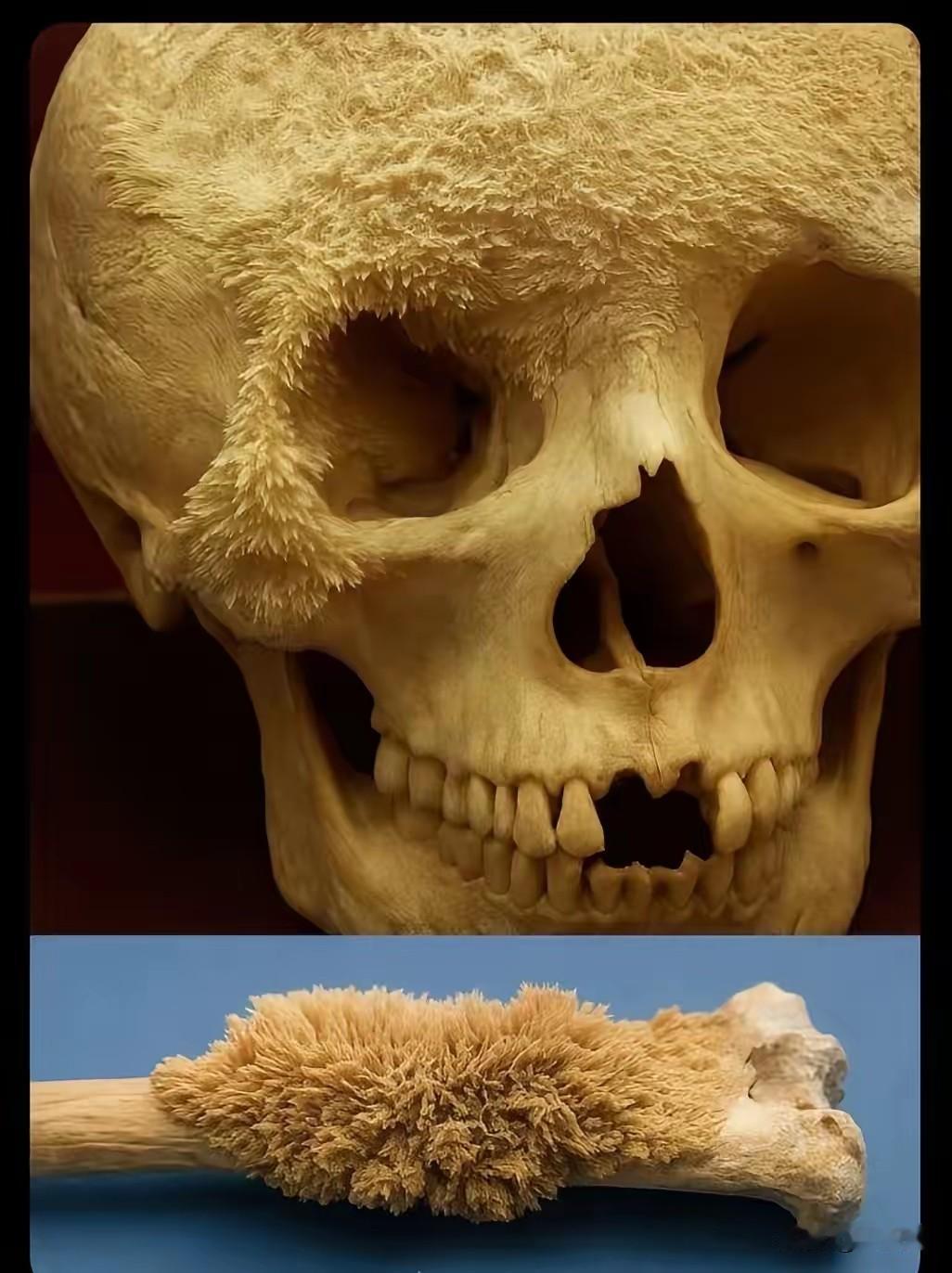 原来骨癌真的让人痛不欲生，这是一名骨刺患者的骨头，上面密密麻麻的骨刺每一根都在刺