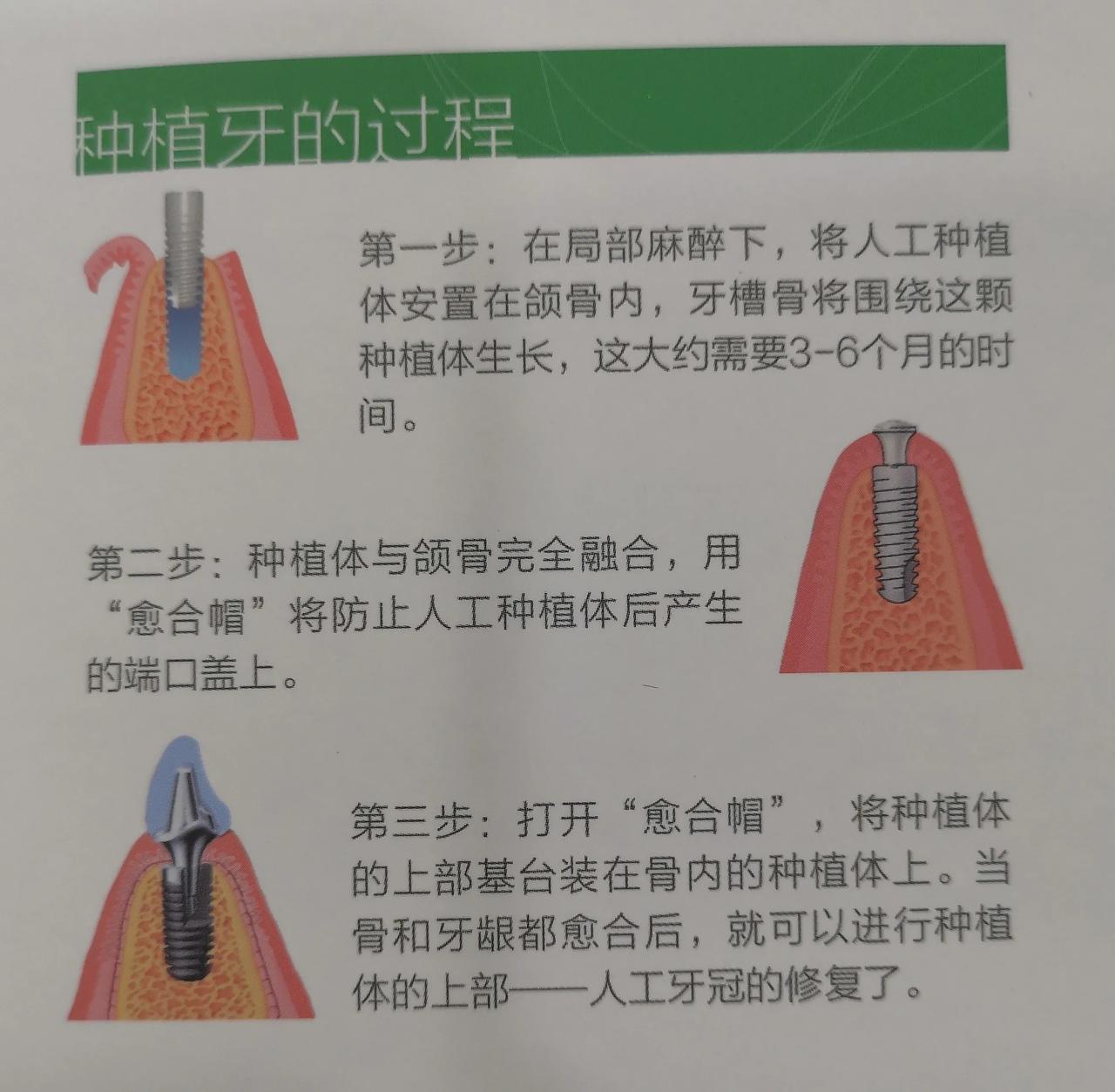 #2023年度创作挑战#人生中三副牙，乳牙，恒牙，种植牙，你在用那副牙