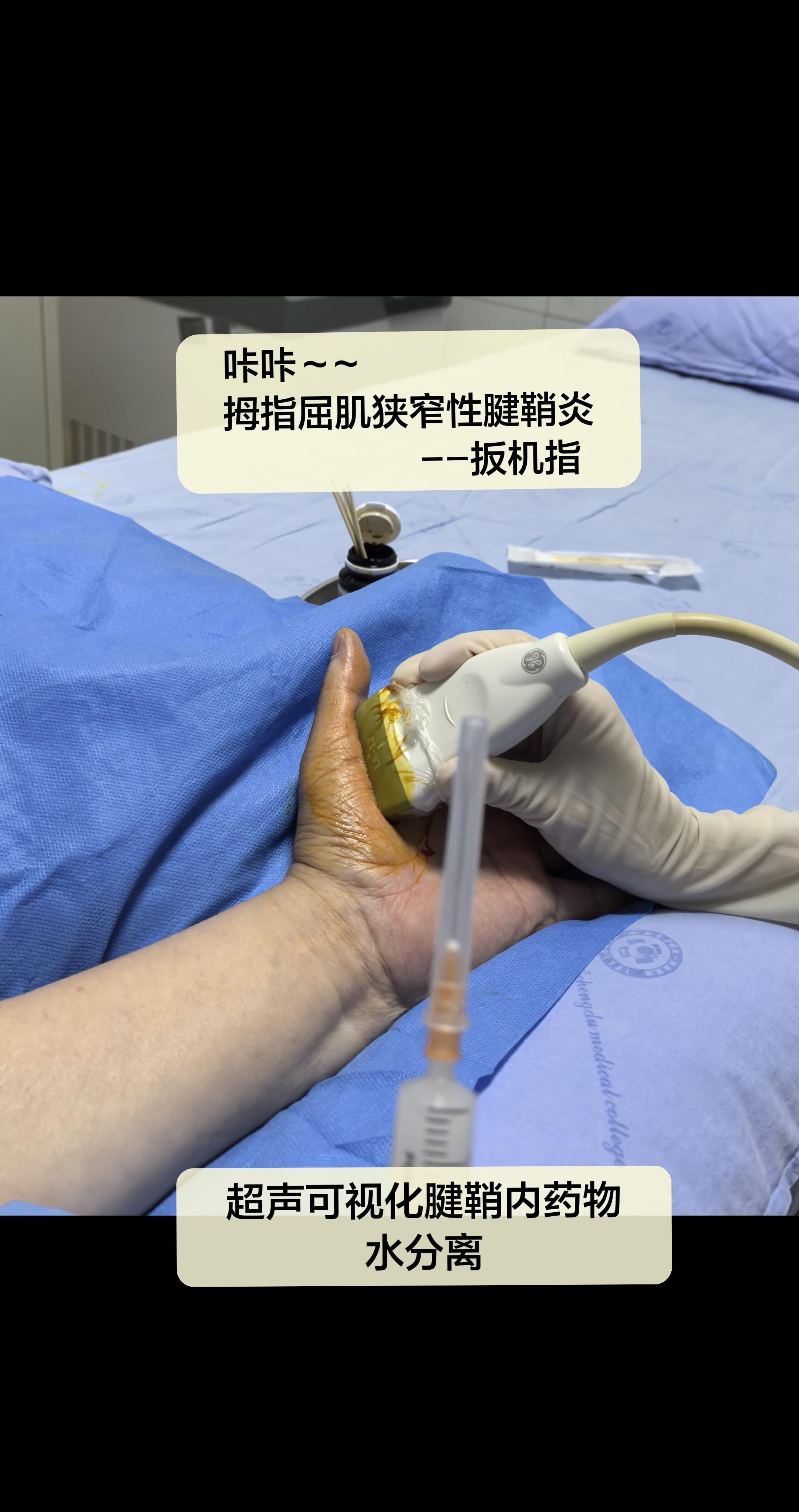 扳机指。好发于中老年人，女性略多于男性。疼痛，活动受限，通常进展性加重...