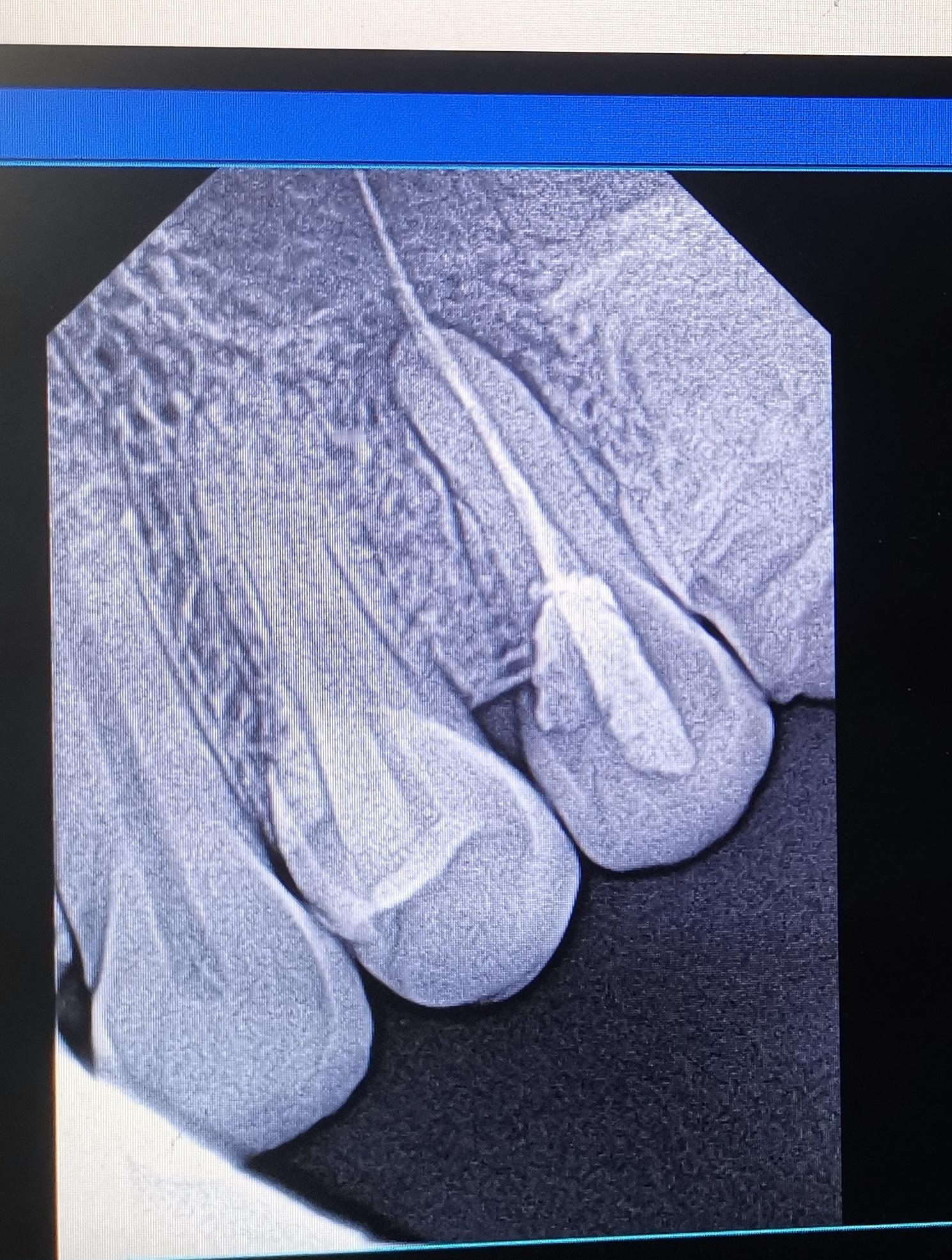 接一例转诊，急性上颌窦炎，发热。 两个月前在一诊所做过根管治疗。我问，当时医生拍