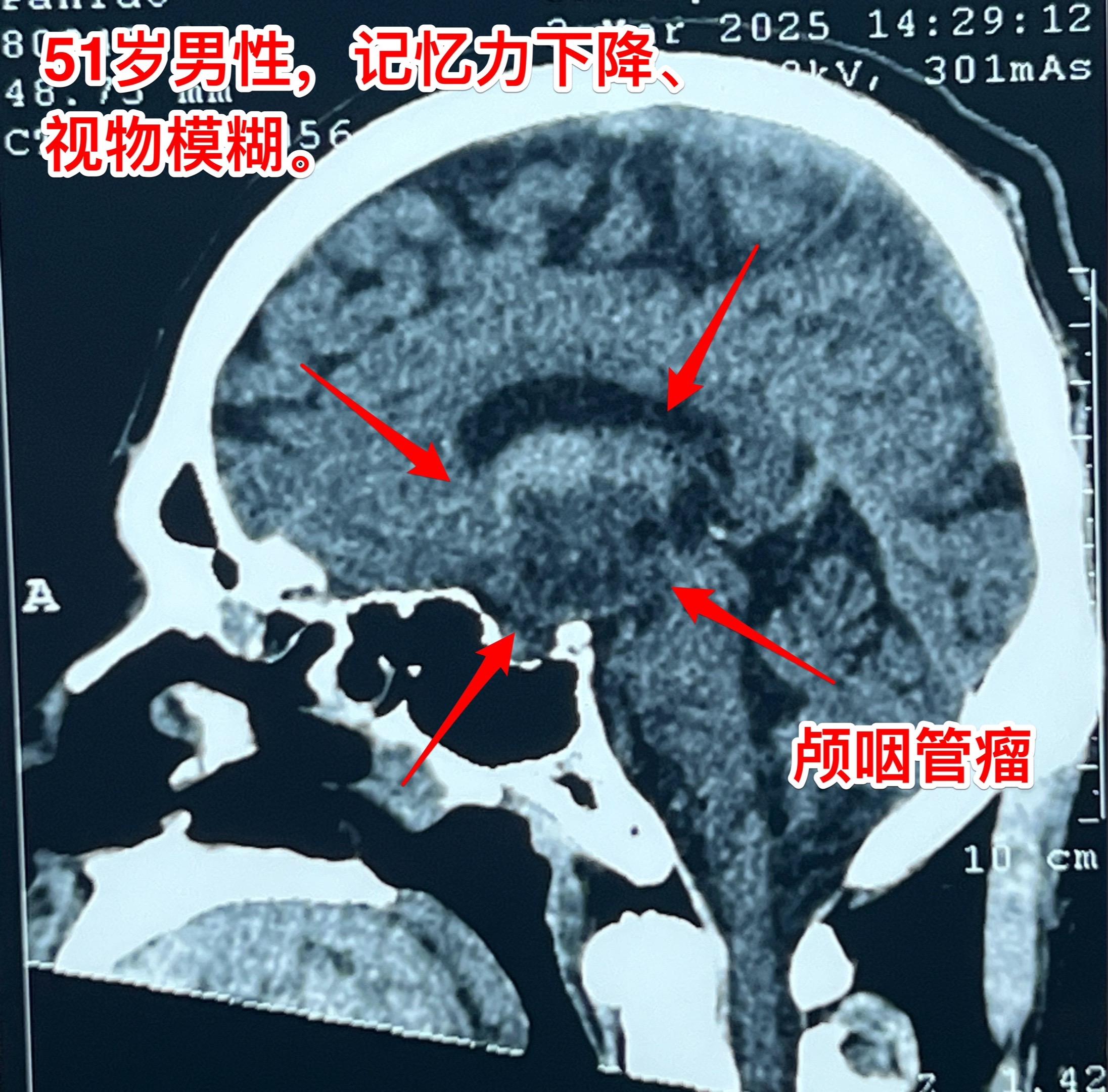 昨日一个颅咽管瘤手术+一个胶质瘤手术。昨日第一个手术：51岁男性，卡车...