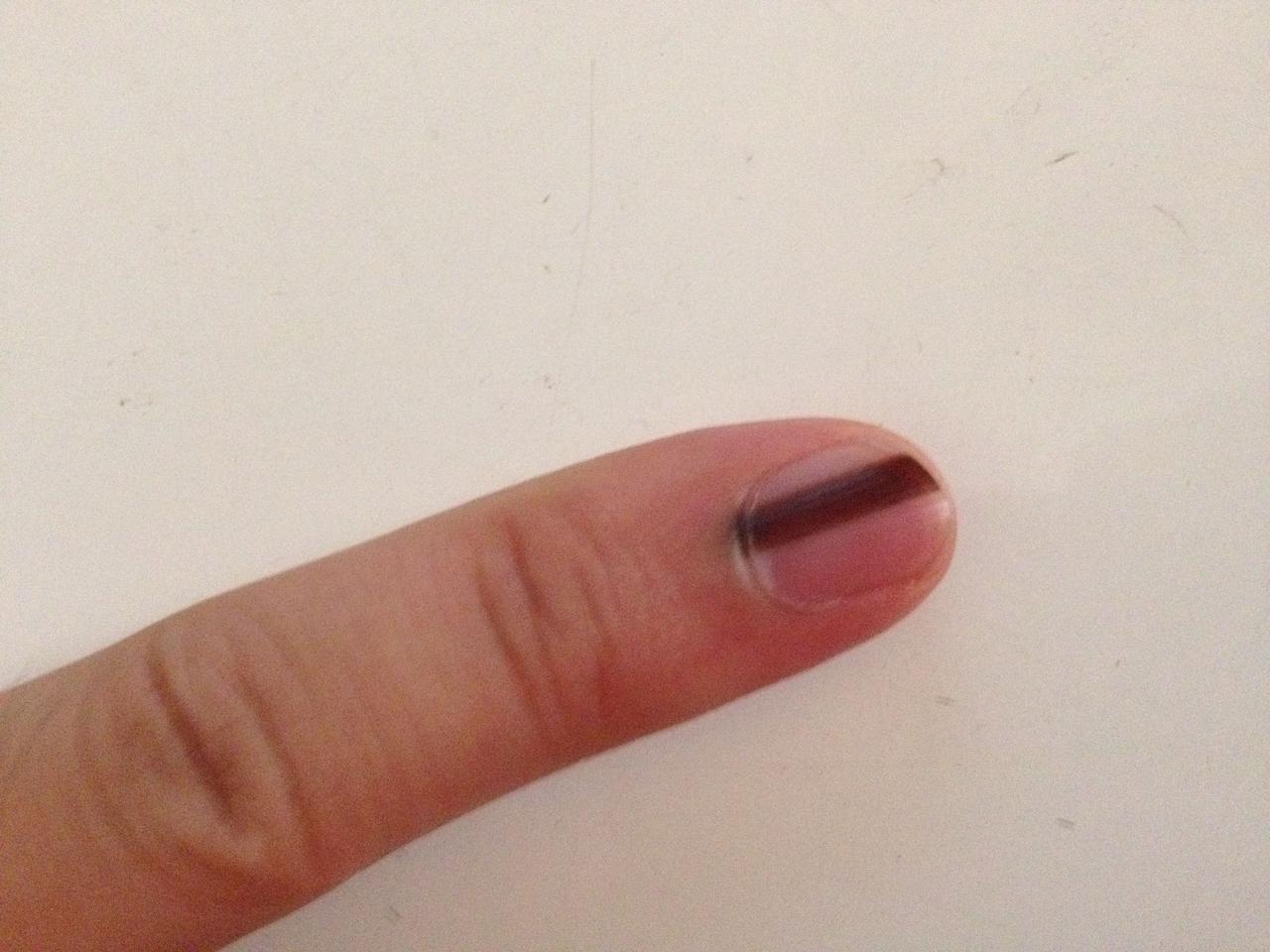 #健康真探社#【你的指甲上有黑线吗？快看看！】很多人都认为，全身上下都有可能长肿