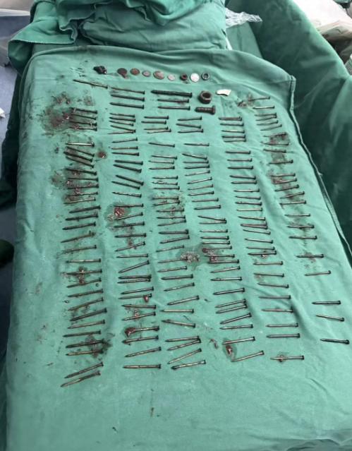 解释不清了！云南，一男子腹部剧痛送医，医生检查后当场被吓退三分：他体内居然塞满了