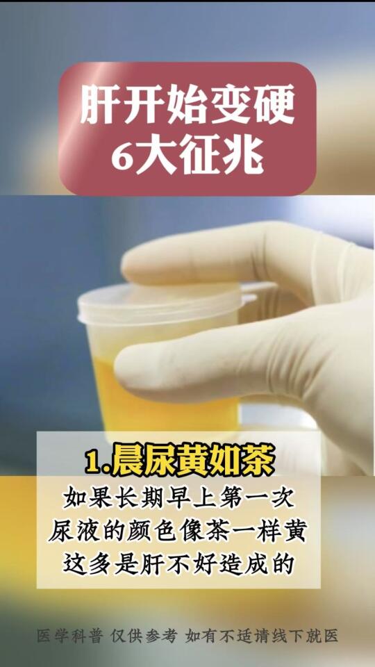 肝开始变硬的6大征兆！
