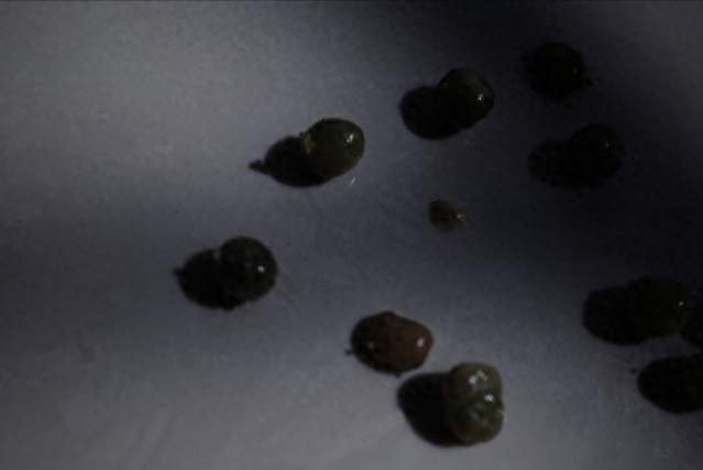 临床待久了，发现了一个规律：凡是有胆结石的，都有3个共同点