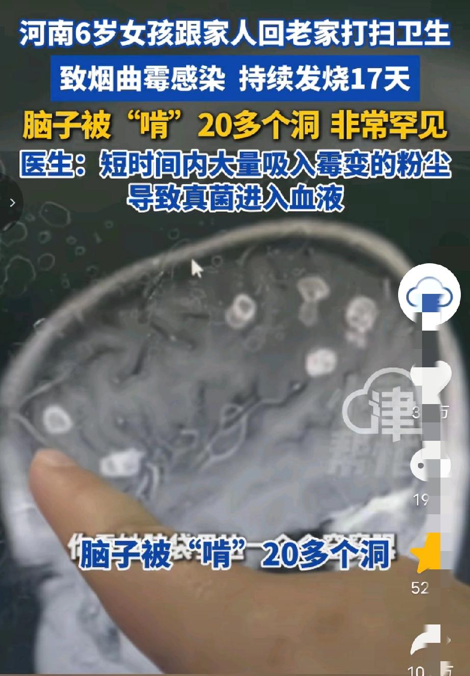 “悲剧还是发生了！”近日，河南一6岁女孩跟家人回老家大扫除，脑袋里长满20多个“