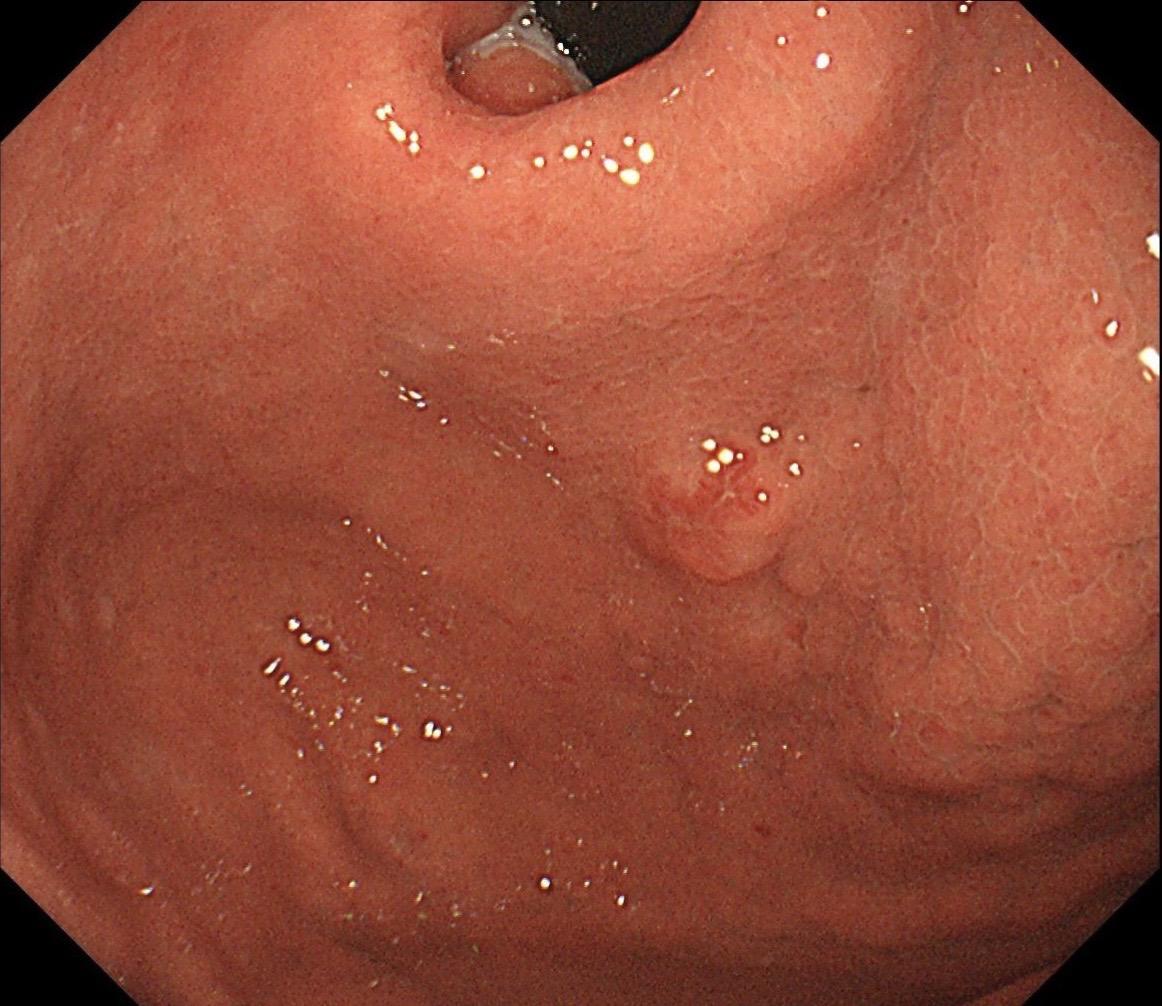 男，70岁，胃底体双发病变。看图猜猜病理呢……尤其胃底这个小的～凹陷性...