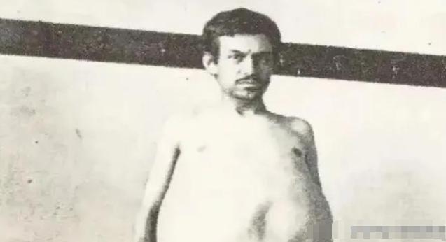 1940年，一位美国男子正在排泄大便时突然死亡，当法医检查过后发现男子体内竟然堆