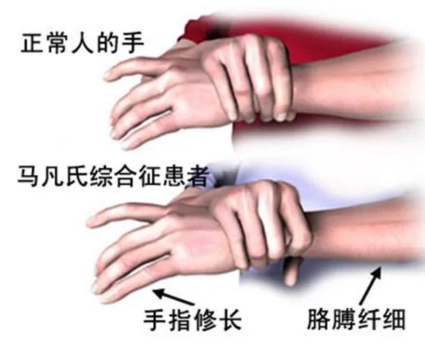 有一种病症，它使患者拥有“修长”的四肢，本该是人生的加分项，却在身体的各个部位“挖坑”，使患者饱受折磨。它就是马凡氏综合症！眼睛最常见的就是晶状体半脱位！！！