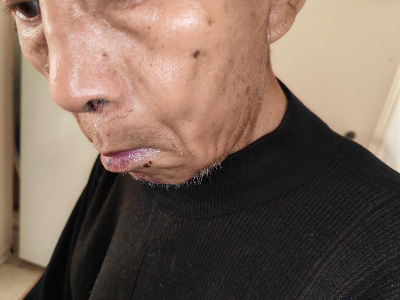前两天，我老伴一觉醒来，左脸无缘无故的突然肿了起来。

左边的脸肿得都有些变形了