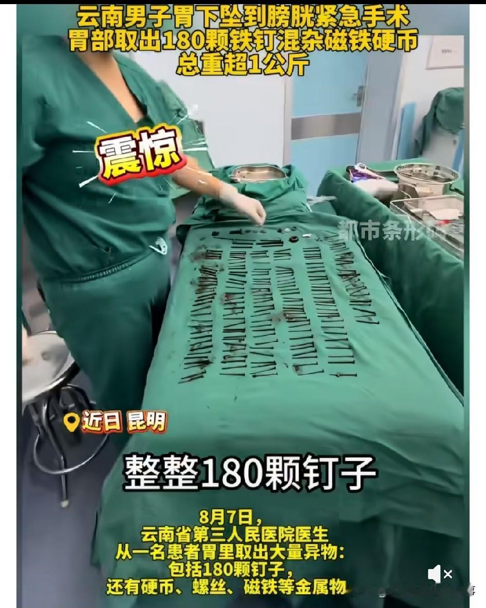📍震惊[震惊][震惊]昆明一中年男子胃里取出180颗钉子❗️这新闻看得我头皮直