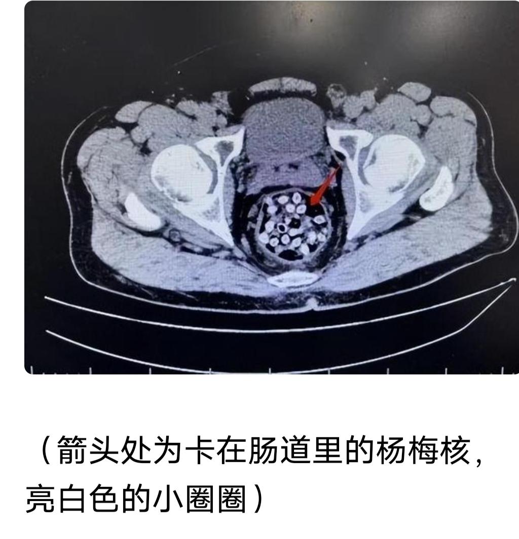 每年杨梅上市，网上总流传一个偏方：吃杨梅把核吞下去，能润肠通便。不少老人、肠胃不