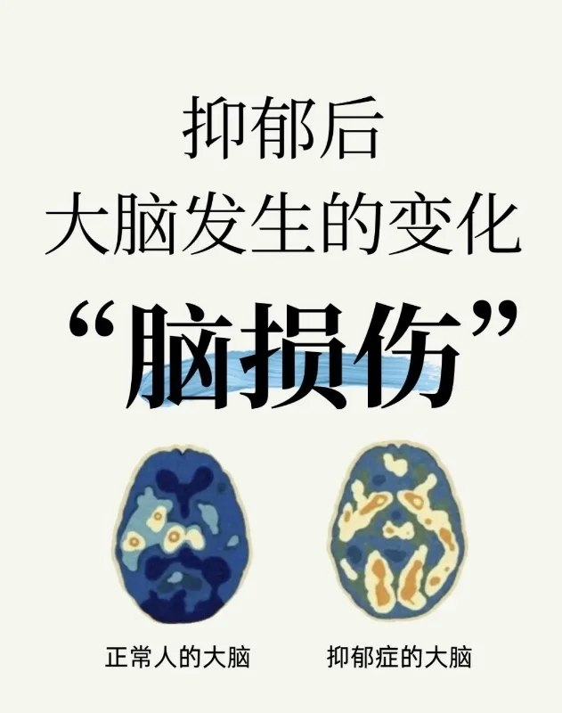 抑郁后大脑发生的4个变化，你知道几个？ （1）前额叶皮层萎缩 （2）前...