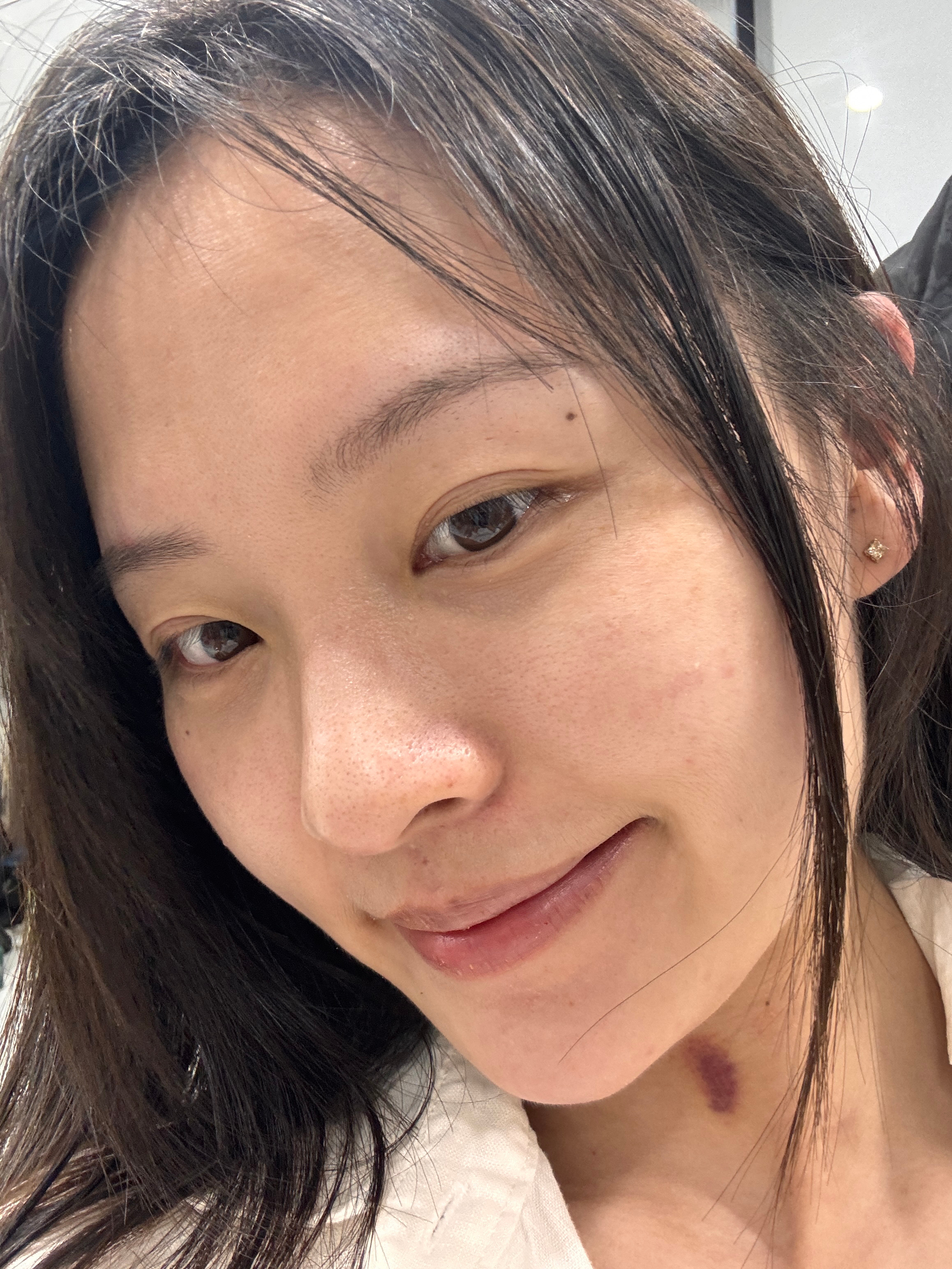 过敏终于要好啦就是为何嘴角又烂了呢？求解