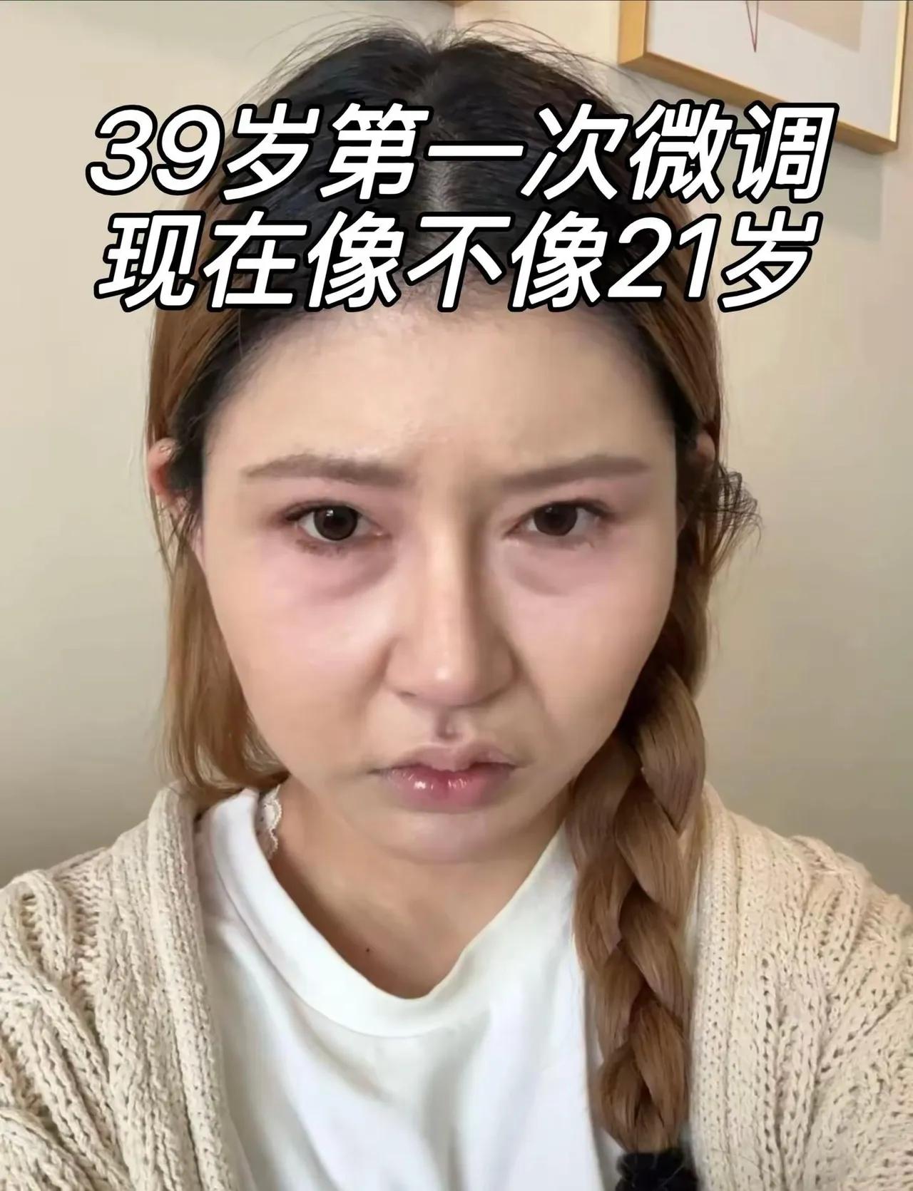 这或许就是很多人想整容的原因吧？
简直就是换脸，回家爸妈根本不认识，身份证都得重