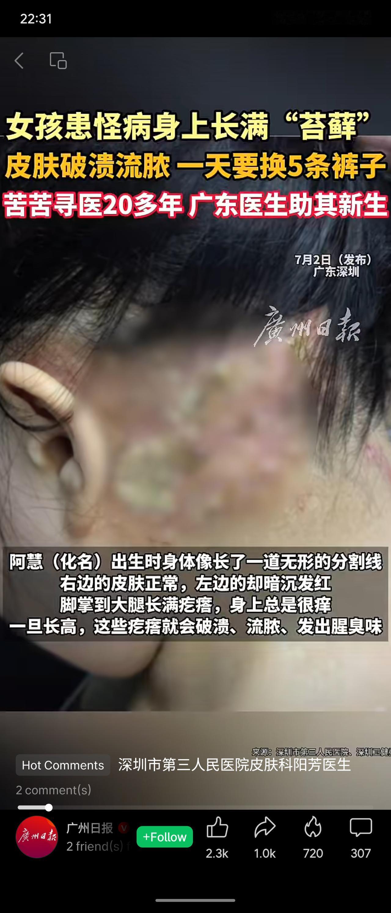 阿慧出生即患罕见CHILD综合征，左半身长满“苔藓”样疙瘩，破溃流脓日换裤5条，