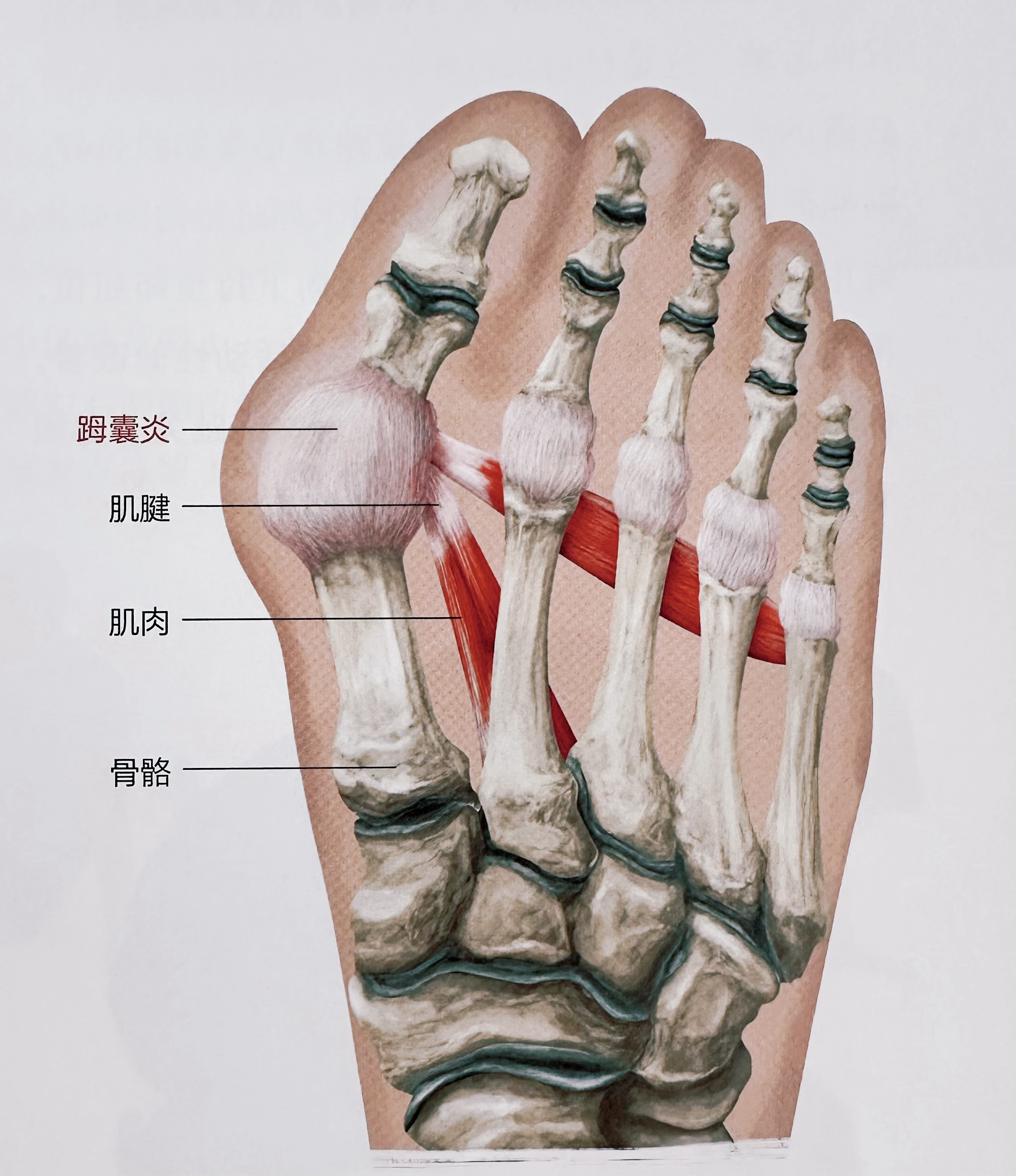 足踝疼痛  除了足底筋膜炎，足踝还有哪些常见损伤？① 小腿拉伤② 跟腱病（跟腱撕