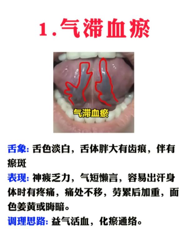 血瘀分 5 种，对照舌象和症状，看看你是哪一种？