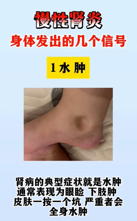 慢性肾炎来临，身体会发出 4 个信号，别忽视