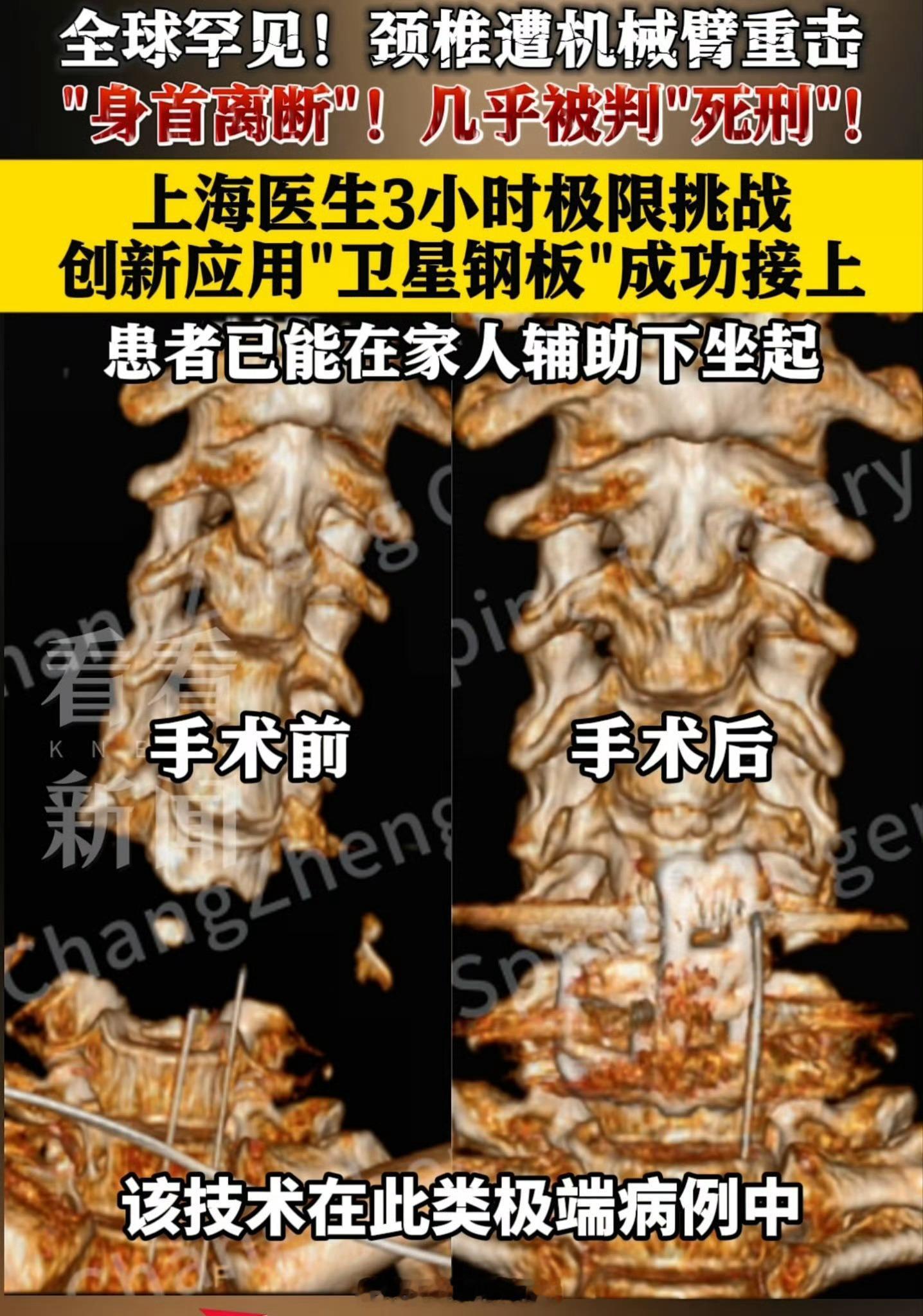 真的是厉害！这事搁在以往任何年代，都是必死无疑。主刀医生回应身首离断患者被救回 