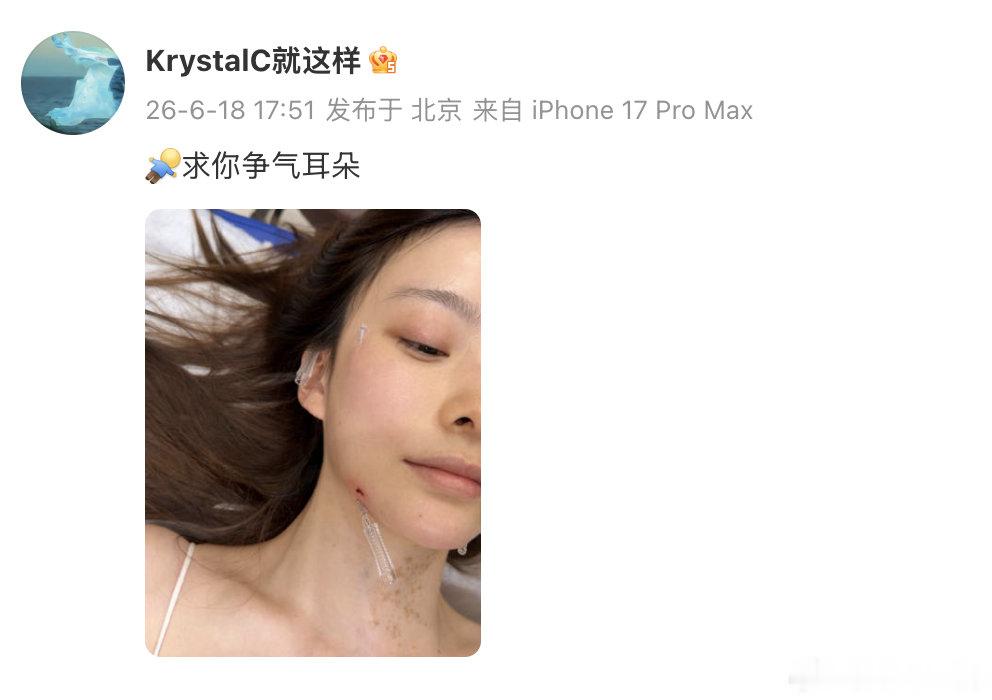 陈卓璇被确诊咽鼓管异常开放症陈卓璇做针灸治疗耳部病情 陈卓璇晒出针灸治疗耳部的日