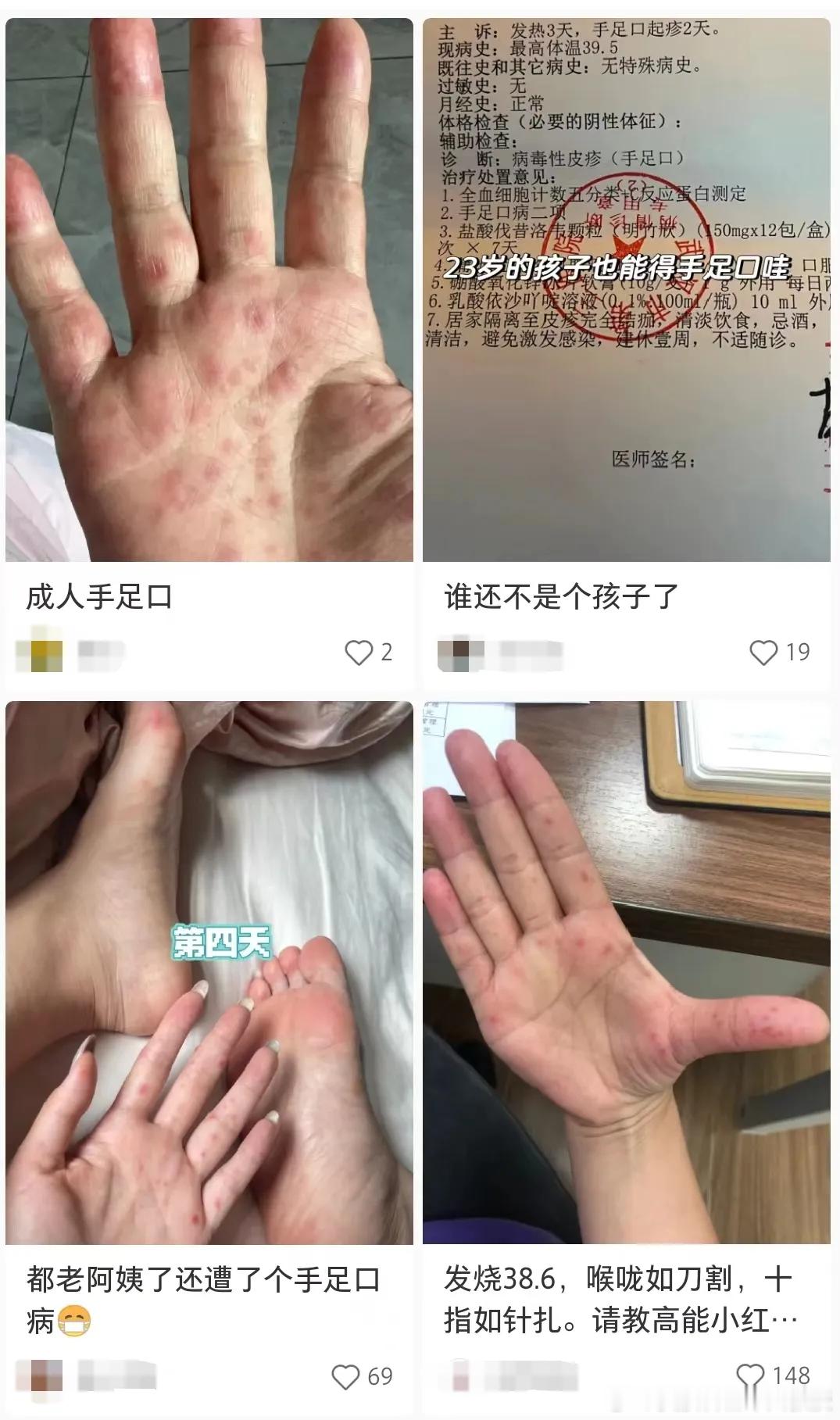 #疱疹性咽峡炎高发季# 夏季是疱疹性咽峡炎、手足口病高发季，两者都是由肠道病毒引