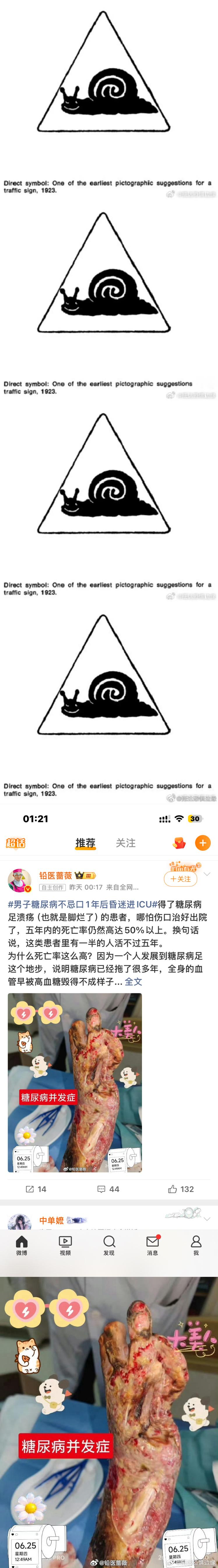 主页刷到的糖尿病并发症 