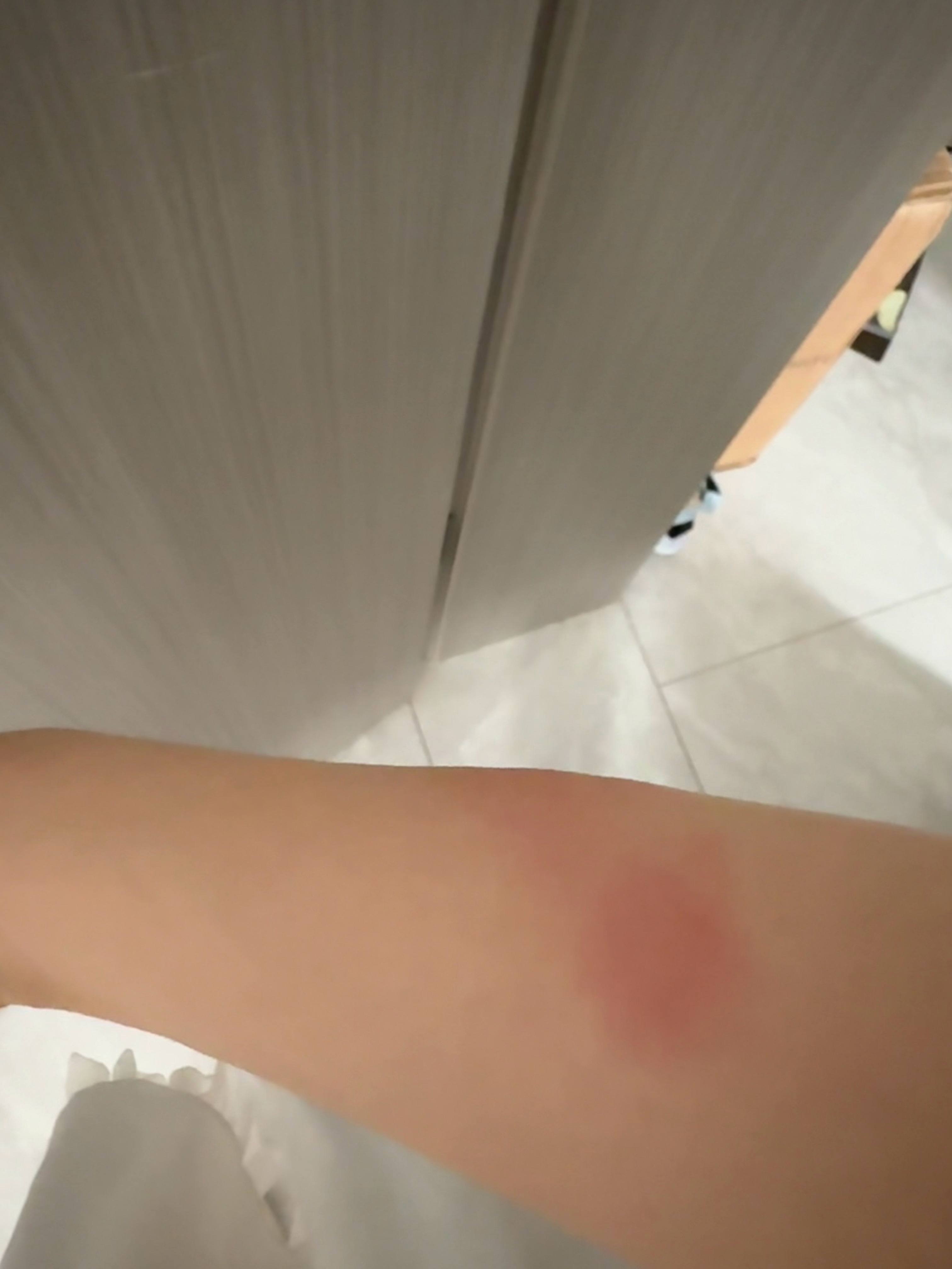 臭蚊子我跟你拼了，红肿大包🧧 ​​​
