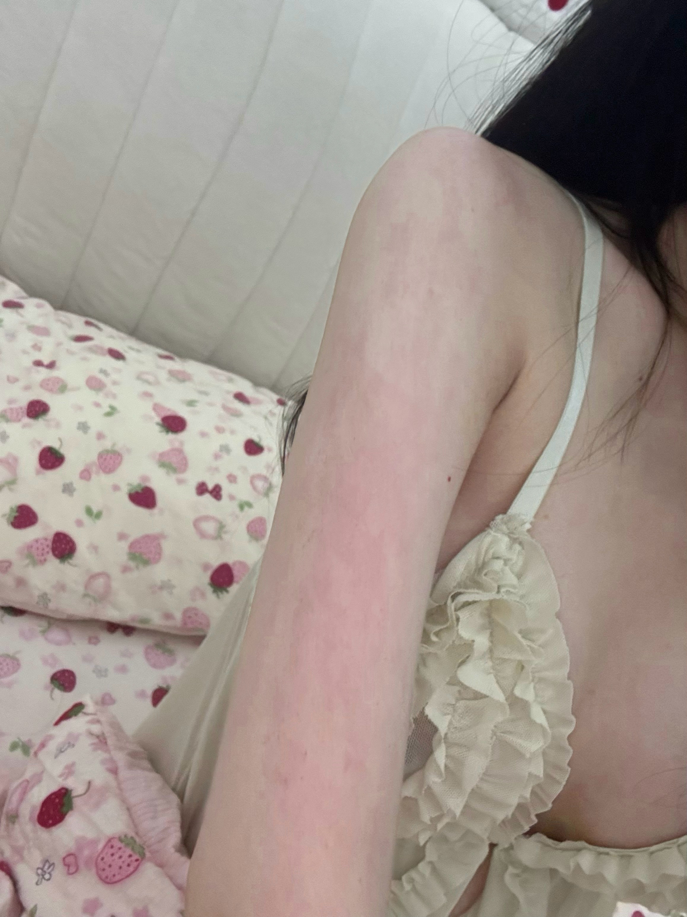 两次全麻后 动不动寻麻疹[微笑] ​​​