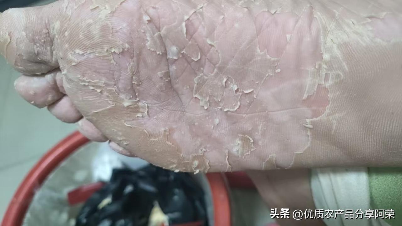 想问问大家，我老婆这是脚气吗？越来越严重，经常帮洗脚，不知道会不会传染？
无处安