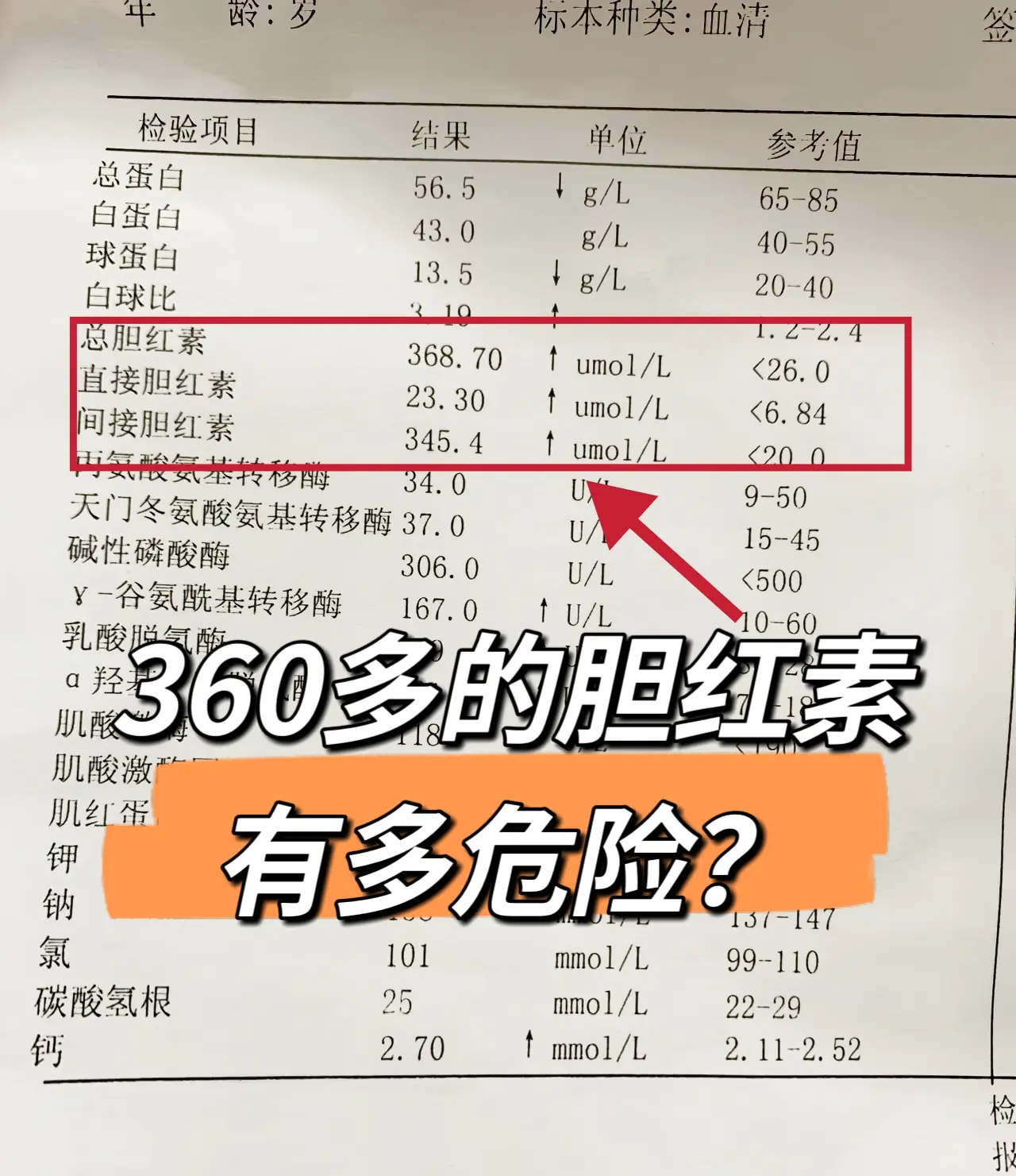 360多的胆红素！胆红素升高到300多，正常情况下是0~20，300多...